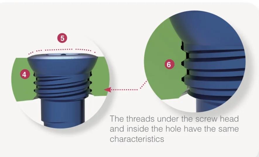 Monoaxial locking fixation - Oneclip